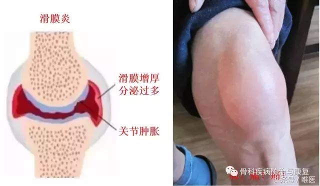 关节无名肿痛是什么原因引起的,关节肿痛无骨折