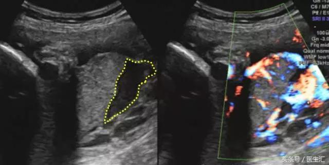 胎盘早剥是什么导致的,胎盘早剥是什么原因造成的胎儿肺炎