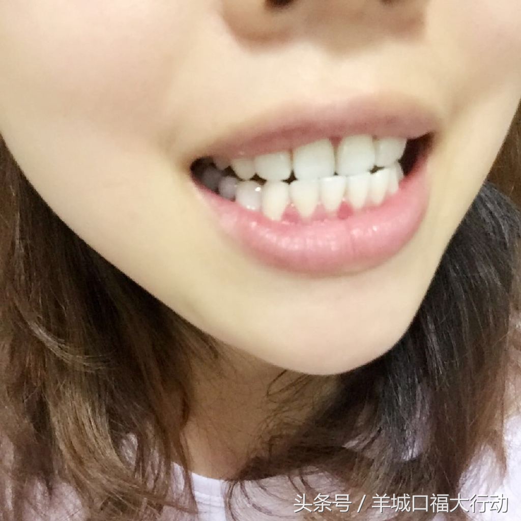 牙齿烂掉一半是拔掉还是根管治疗,牙齿烂掉一个