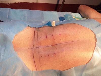 治疗腰椎间盘突出最佳最有效方法,腰椎间盘突出治疗视频大全