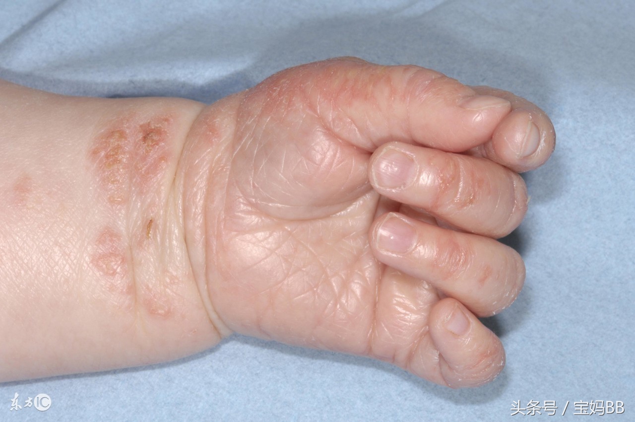 奶粉中什么促进毛发生长预防湿疹,新生儿热疹和湿疹的预防与护理