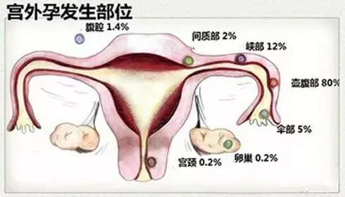 无瘢痕手术:单孔腹腔镜,让爱美女性不再为“疤”苦恼
