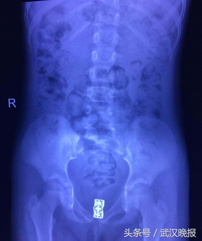 8岁女童3年来下身反复出血流脓发出恶臭原来是一根铁发卡惹的祸