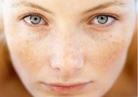 鼻梁黑色素沉积怎么办,鼻梁两侧黑色素沉积怎么遮