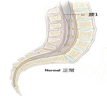 脊髓栓系松解术手术记录,天坛医院治疗脊髓栓系案例