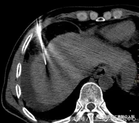 治癌手术,肿瘤消融术能治什么癌症