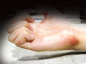 我的腱鞘炎治疗过程记录,医生解决腱鞘炎最简单自愈方法