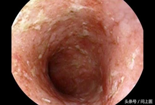 溃疡性结肠炎初期症状及治疗,溃疡性结肠炎症状最新治疗方法