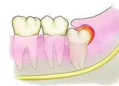 智齿发炎缓解最快最有效的方法,长智齿但是不能拔牙怎么办
