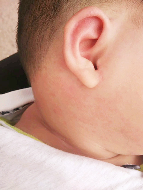 孩子剪完头发背后起疹子,小孩剪完头发后全身长红疹