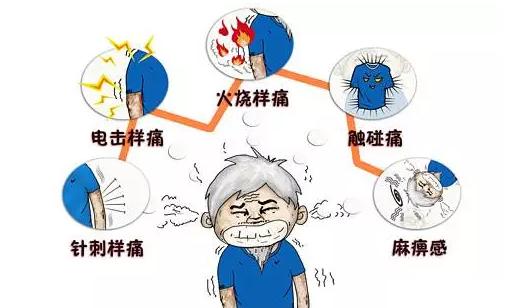 带状疱疹后遗神经痛针灸,带状疱疹后遗神经痛贴膏