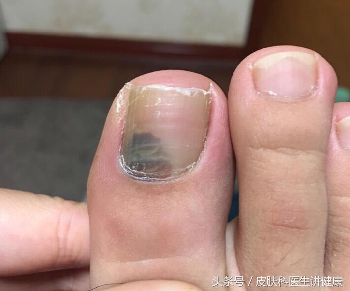 色素痣会出现大面积皮肤发黑吗,如何区分黑斑与色素痣