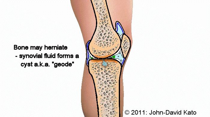 全球首例澳洲宣布彻底治愈关节炎,澳洲医生发现关节炎特效药