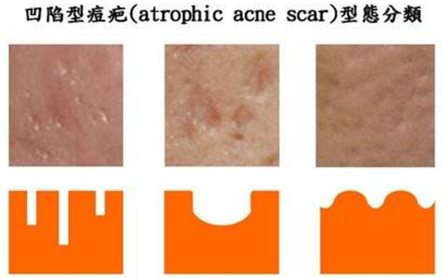 专家推荐祛痘方法,医生推荐祛痘痕痘印最有效的办法