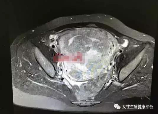 50岁女子10年长了108个子宫肌瘤,女子子宫肌瘤10年不治竟取出109颗