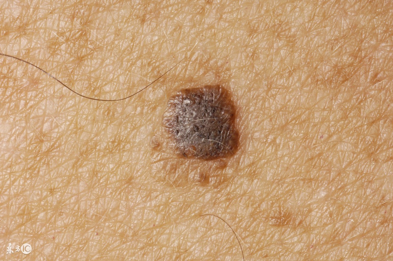 教你如何去掉皮肤上的老年斑,皮肤科医生去除老年斑