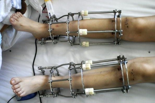 苏联发明断骨增高术,骨科医生神奇疗法