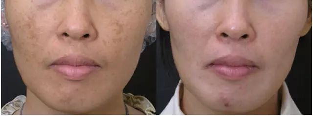 脸上突然出现很多褐斑,脸上褐斑的最好治疗方案