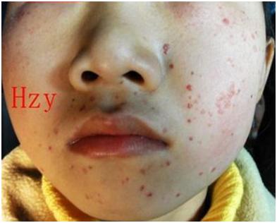 剧烈呕吐脸充血起红点怎样消除,剧烈呕吐后出现紫癜