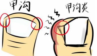 甲沟炎怎么治疗能彻底除根,脚趾甲沟炎怎么治疗最有效