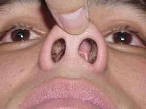 得了鼻炎有什么办法好得快,得了鼻炎怎么吃药