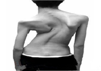 强直性脊柱炎晚上背痛怎么办,强直性脊柱炎晨起背痛怎么办