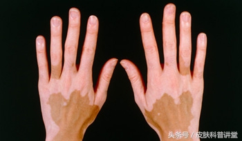 白癜风最新治疗方法录音,白癜风的治疗新进展