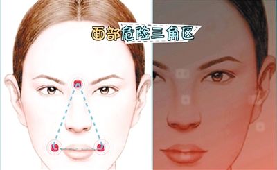 用手挤脸上的痘痘,挤脸上的痘痘会爆炸