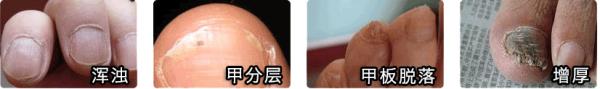 灰指甲是怎么形成的有什么危害,灰指甲是什么样子对身体有何危害
