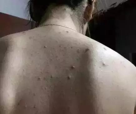 背后长了很多的小米粒用什么药,为什么会长了好多小米粒疙瘩