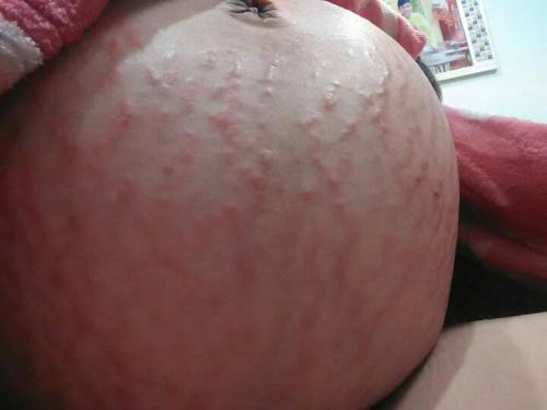 产后橄榄油可以去除妊娠纹吗,产后祛除妊娠纹最有效的方法