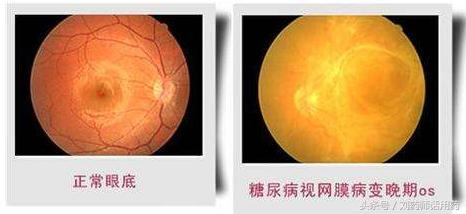 2型糖尿病空腹血糖高的原因,2型糖尿病空腹血糖6-7危害大吗
