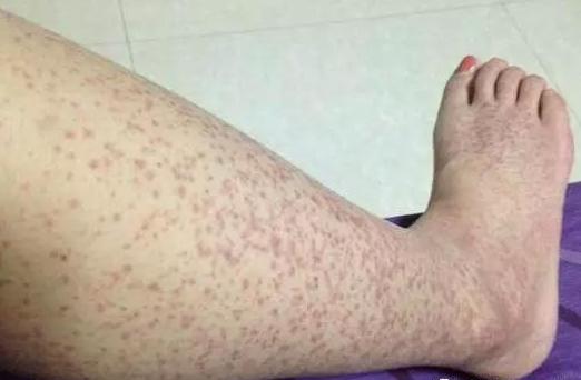 如何诊断过敏性紫癜损害肾脏,北京儿童医院看过敏性紫癜名医