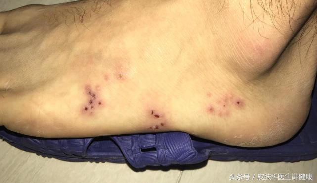 脚上起疱疹不痒但是痛,脚上长水泡要弄破吗
