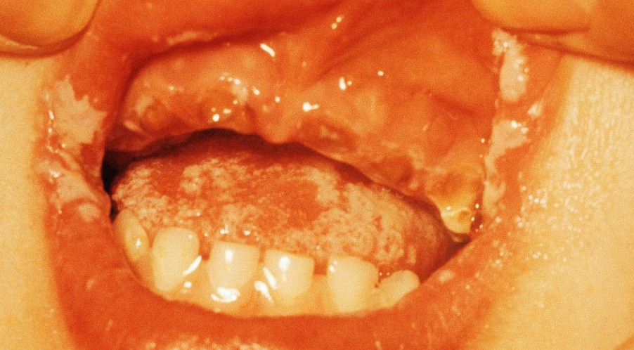 对于真菌感染的皮肤病怎么治,真菌感染皮肤问题的克星