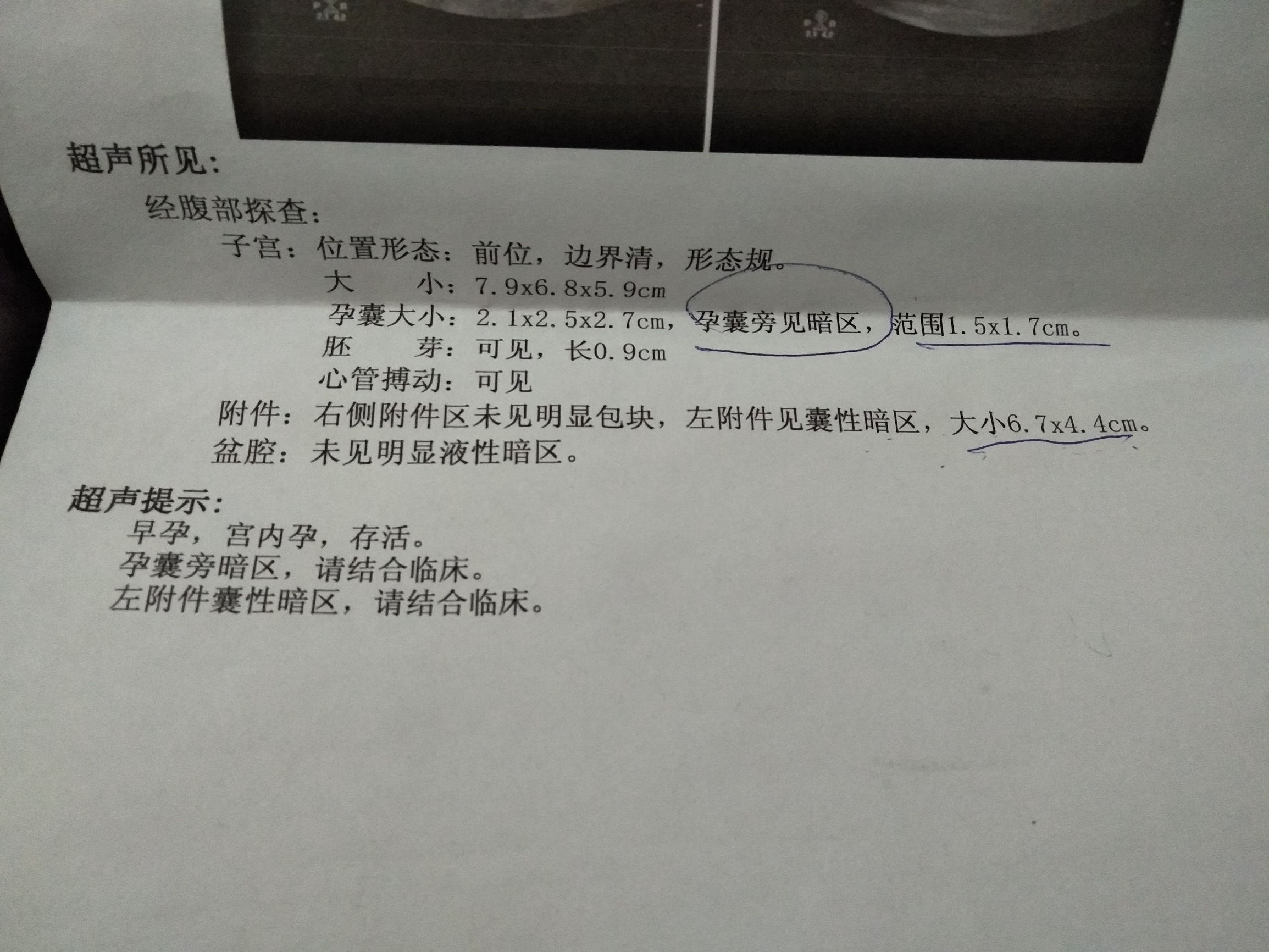 孕30周胎盘低置轻微出血淡红色,孕囊旁有液性暗区考虑积血可能