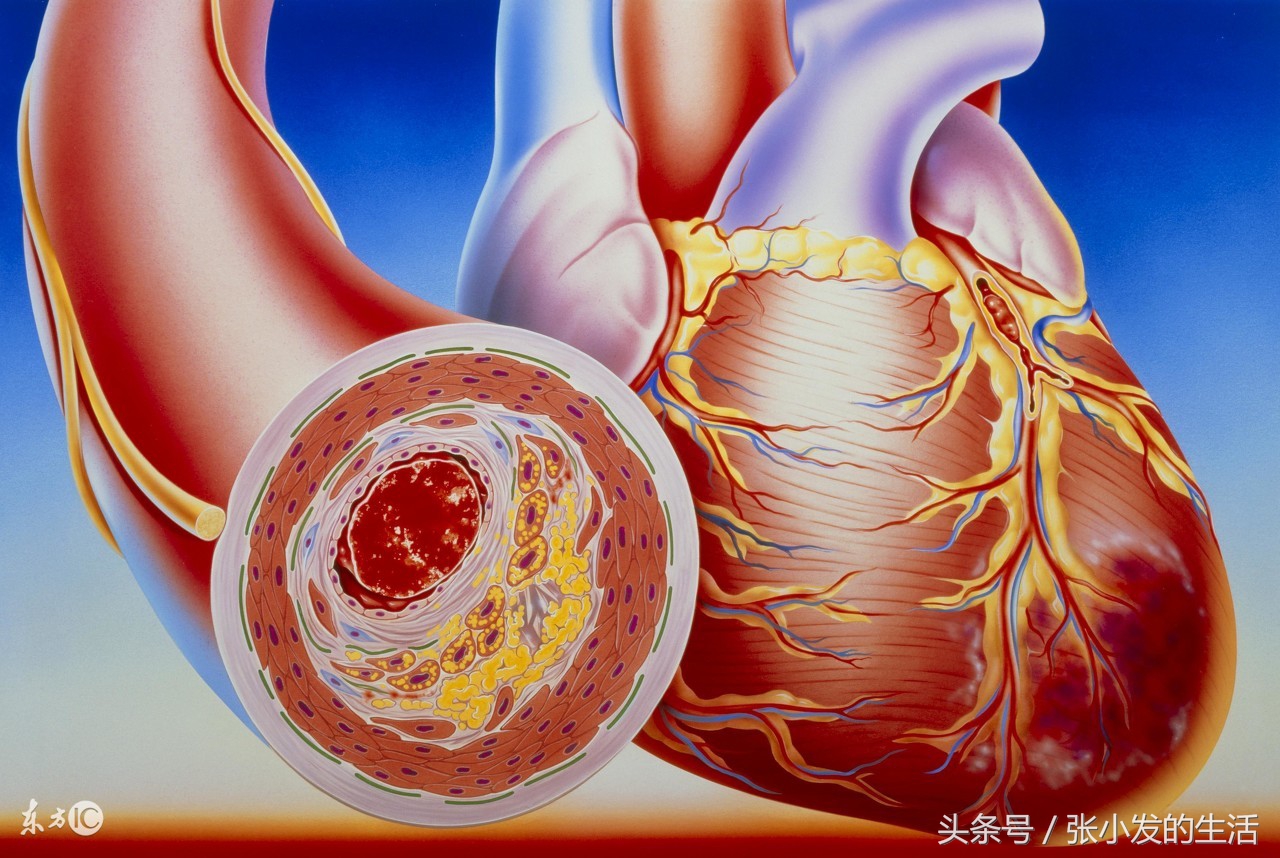 心绞痛与急性心肌梗死的鉴别,不稳定型心绞痛和急性心肌梗死