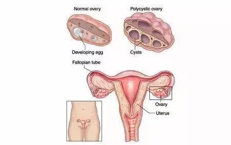 多囊卵巢综合症的症状完全指南,如何有效地治愈多囊卵巢综合症
