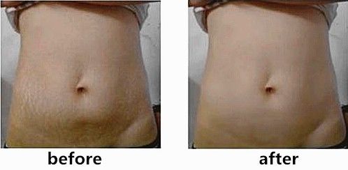 深扒“网红”神油,8周改善妊娠纹和疤痕~