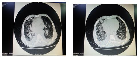 慢性心衰的护理病例讨论,发现有慢性心衰应如何处理治疗