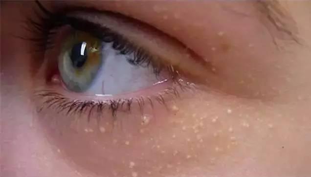 油脂粒留下的洞怎么办,毛孔堵塞凸起有油脂粒怎么去除