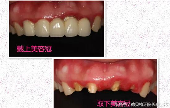 美容冠矫正牙齿有什么危害,美容冠危害图片大全