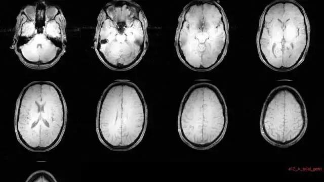 致幻蘑菇病症,致幻类蘑菇的危害