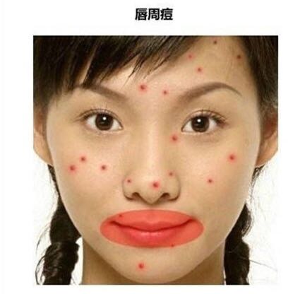 「看图识别长痘原因」还在苦恼长痘，如何祛痘，点开此文绝不后悔