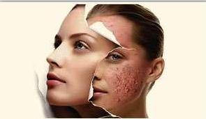 脸上长痘痘了教你一招快速祛痘,脸上痘痘反复长教你一招轻松祛痘