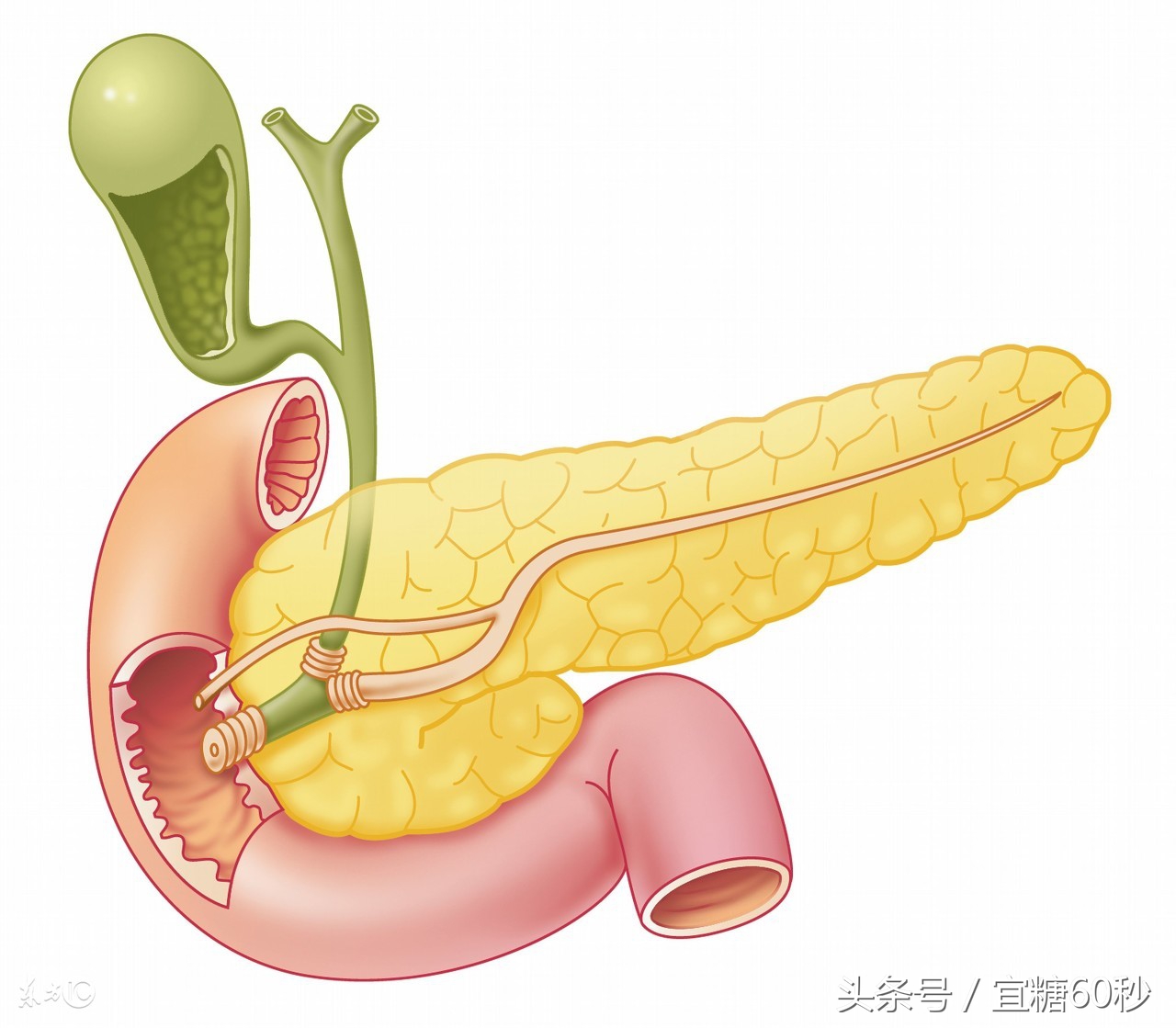 胰岛素分泌高峰延迟是糖尿病吗,血糖正常但是胰岛素分泌高峰延迟