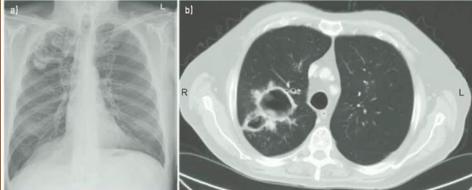 《慢性肺曲霉病：诊断和治疗的理论基础及临床指南》解读