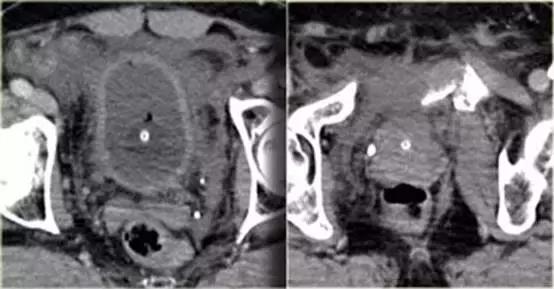 腹腔脏器炎症ct可以查出来吗,膀胱创伤的诊断方法