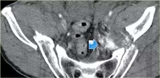 腹腔脏器炎症ct可以查出来吗,腹腔脏器ct表现图像