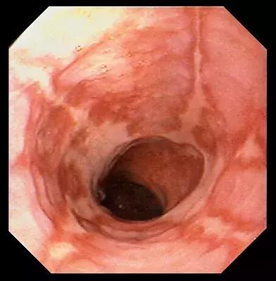 爱喝白酒的人吃东西下咽费劲,爱喝白酒的危害